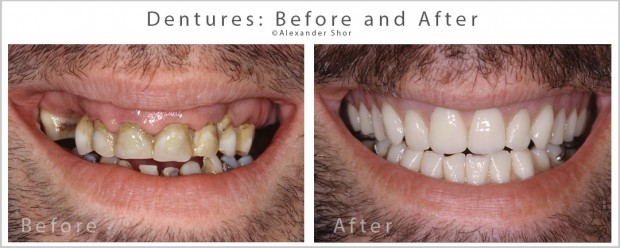 Lower Dentures Won'T Stay In Fort Lauderdale FL 33303